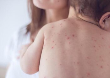 Waspada! Kurang dari Dua Bulan, 1.300 Kasus Campak Ditemukan di Kota Bogor